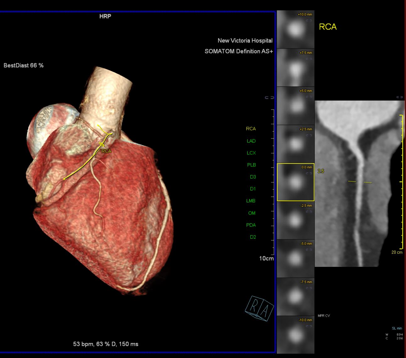 New Non-Invasive CT Coronary Angiogram Service | New Victoria Hospital